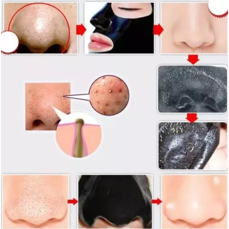 La máscara facial que elimina puntos negros al instante