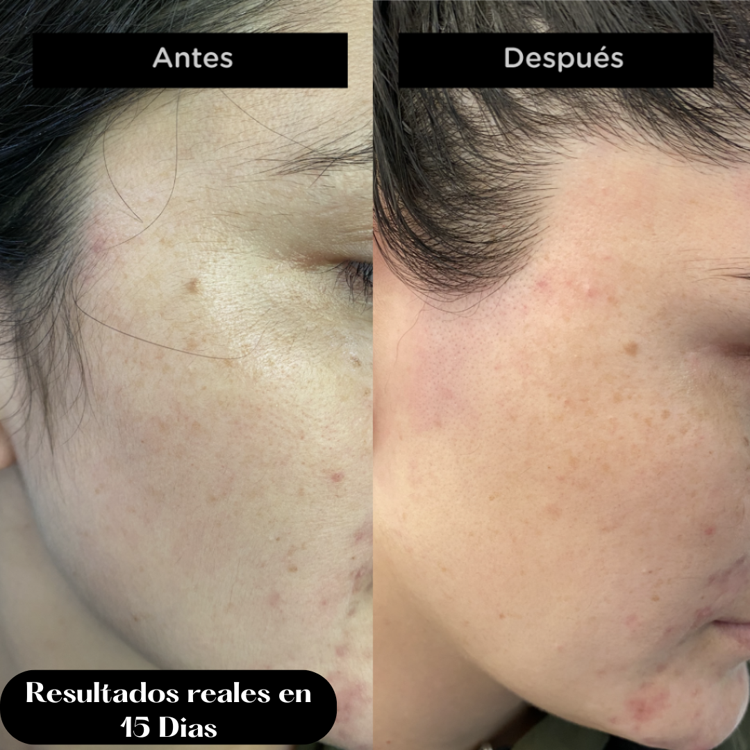 Cara Lisa en 15 Días - LÁSER DEPILATORIO FACIAL PRO