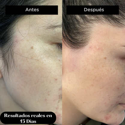 Cara Lisa en 15 Días - LÁSER DEPILATORIO FACIAL PRO